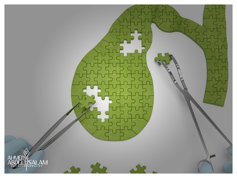 Laparoscopic-Cholecystectomy