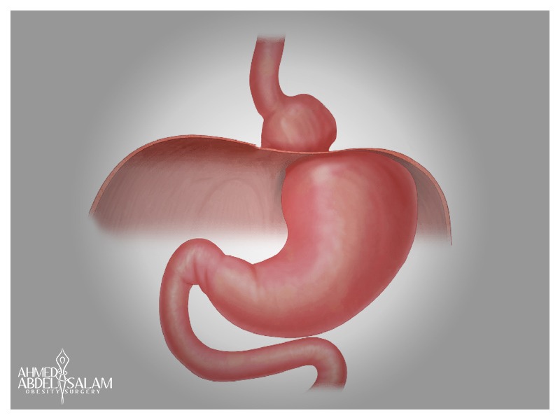 Laparoscopic-Hiatal-Hernia-Repair