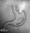 Gastric-Leakage-and-How-to-Prevent-It_c Gastric-Leakage-and-How-to-Prevent-It_c
