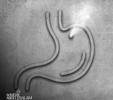 Gastric-Leakage-and-How-to-Prevent-It_c