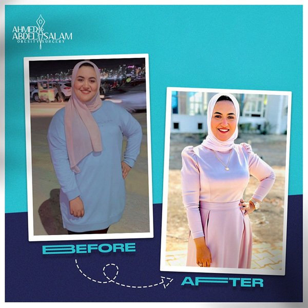 Salma experiences a real change with Gastric Sleeve