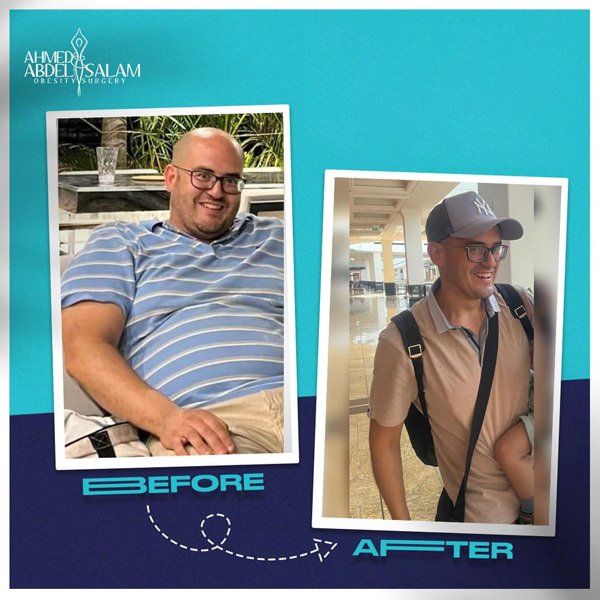 The Youth Return Quickly with Gastric Sleeve